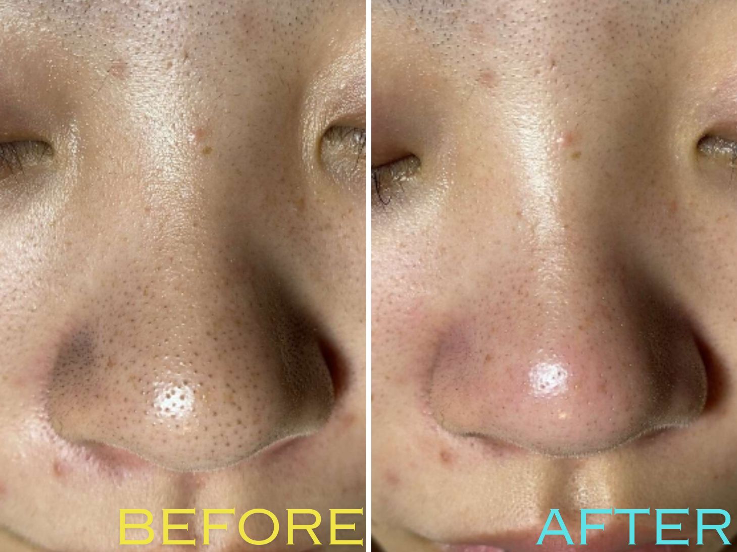 ニキビ・吹き出物に腸活を！/Clear Skin Starts with Gut Health