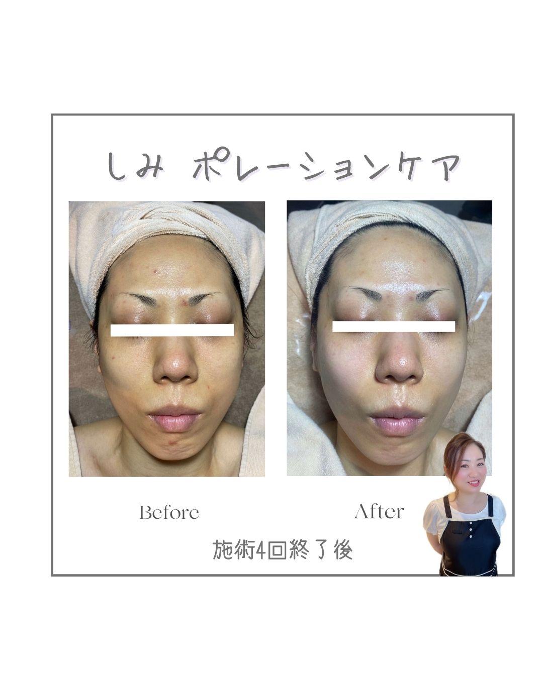S様症例写真:くすみの原因は。。。