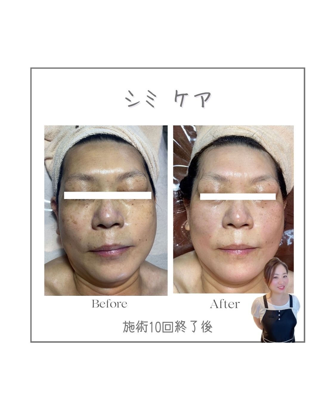 H様症例写真:60歳からでも大丈夫!