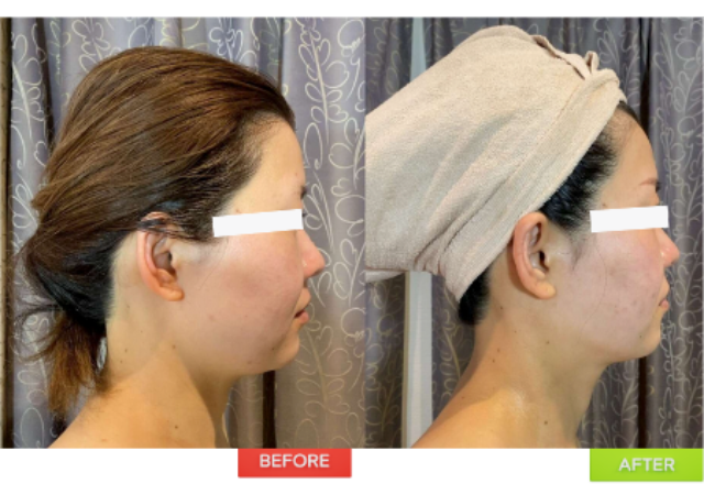絶対結果出せます！Wアップフェイスリフト&小顔矯正/Guaranteed Results: Dual Lift & Face Slimming