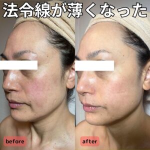 インディバフェイシャルは最強のエイジングケア！ 