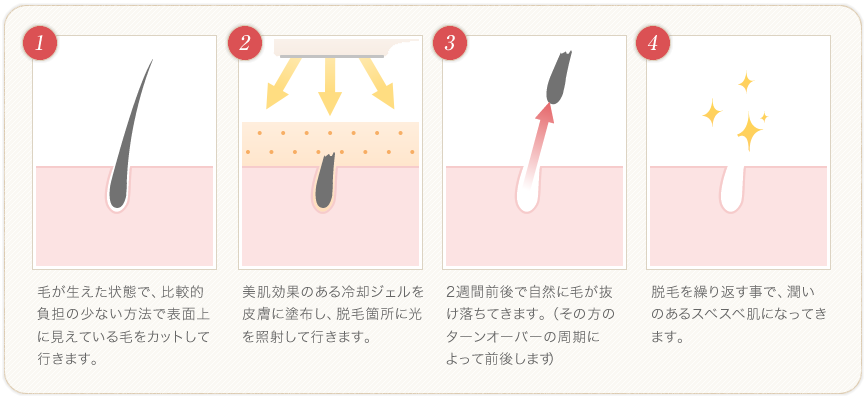 お肌に優しいIPL脱毛