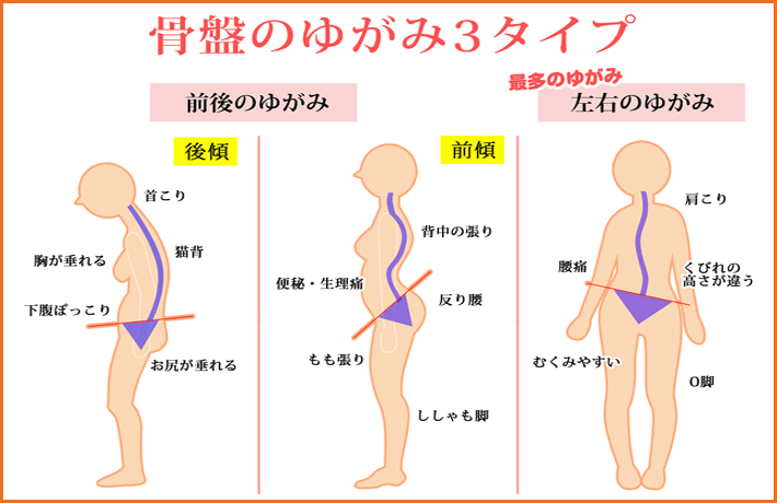 あなたの骨盤ﾀｲﾌﾟはどのタイプ