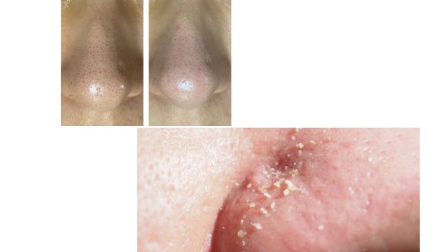 薬には頼らない30代からのニキビケア♪/Clear Skin Without Medication at Lady Luck