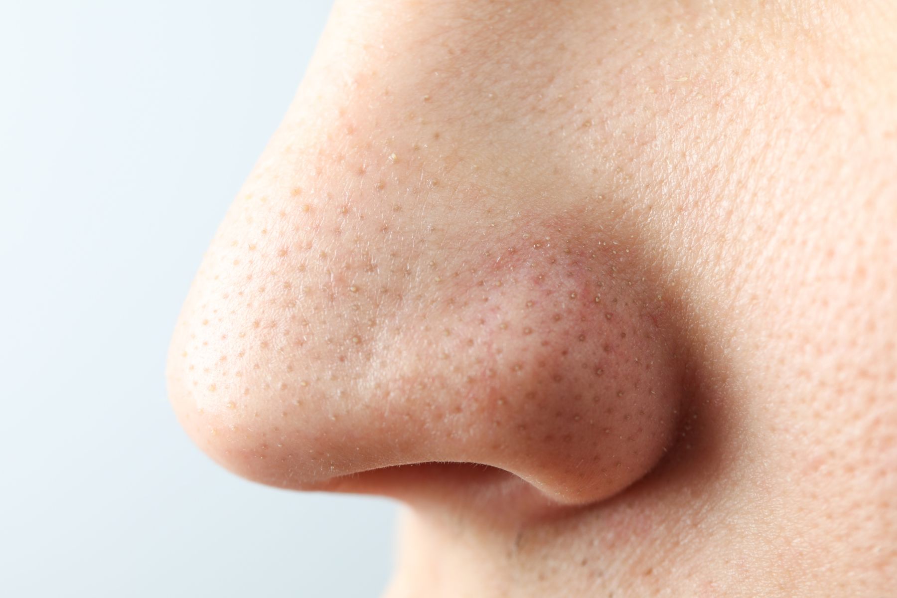 毛穴が綺麗にならない原因はご存知ですか？Do You Know Why Pores Stay Clogged？