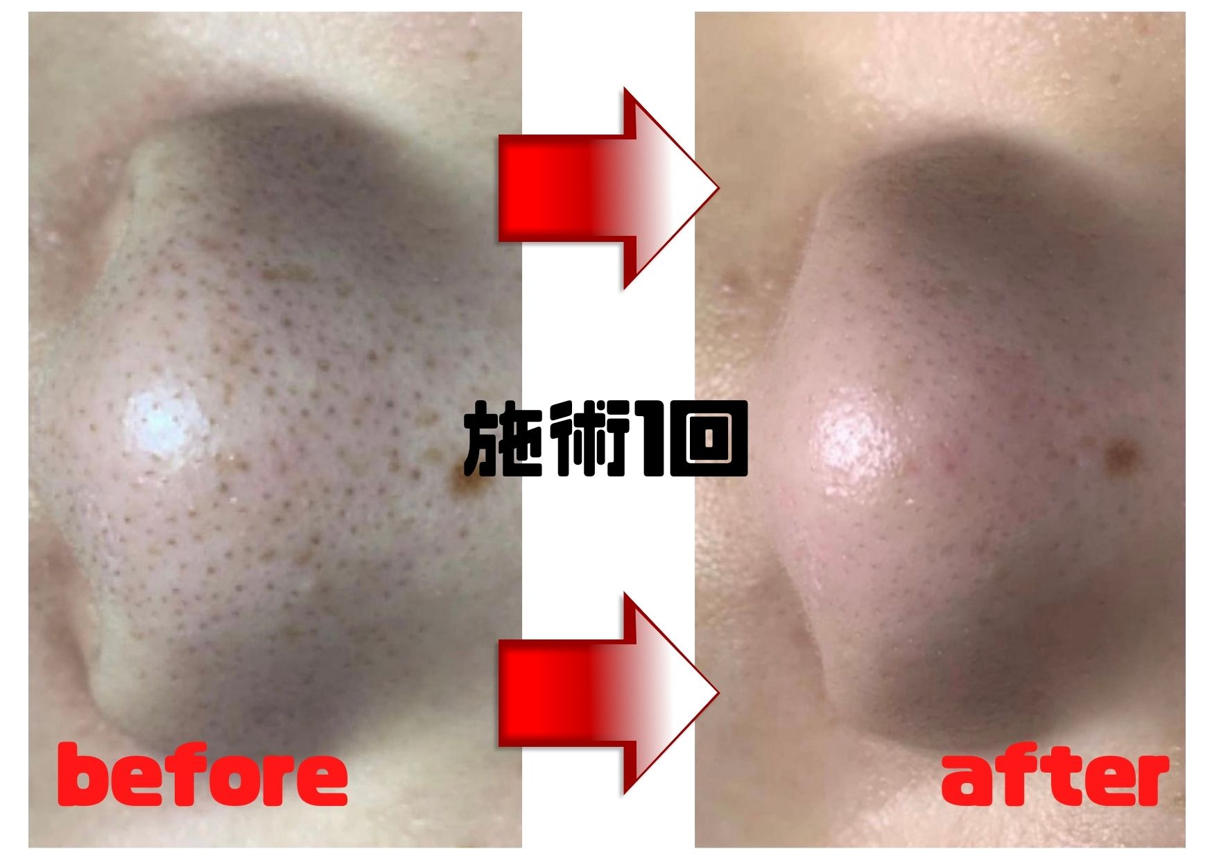 なぜ？取っても取ってもなくならない角栓/Why Blackheads Never Go?